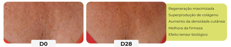 Antes e depois PDRN Phycopeptide D0 vs D28