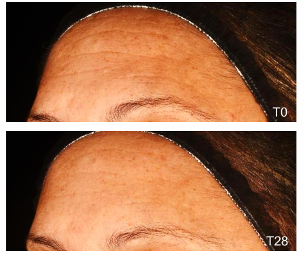 Resultado Lactopalm Para — melhora de rugas T0 vs T28
